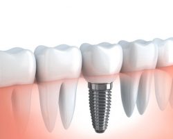 dental_implants_2 | Duffield Dentistry - Royal Oak, MI