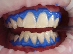 What Can I Do About Stained or Discolored Teeth?