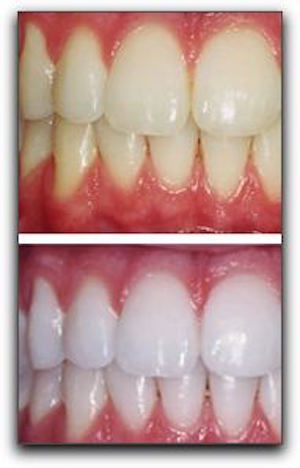 Professional Teeth Whitening Is Right Choice In Royal Oak
