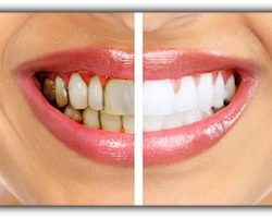 dentist-3-tooth-stains | Duffield Dentistry | Dentist Royal Oak, MI