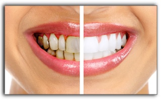 Teeth Whitening For 3 Types Of Tooth Stains In Royal Oak