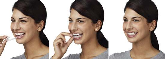 Invisalign clear braces is one of the best teeth straightening methods.