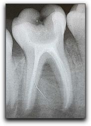 Root Canals in Fort Lee