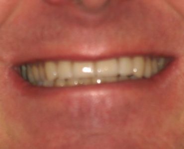 jeff_after - Smile Gallery | Duffield Dentistry - Royal Oak, MI