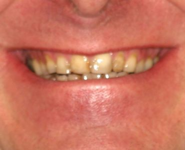 jeff_before - Smile Gallery | Duffield Dentistry - Royal Oak, MI